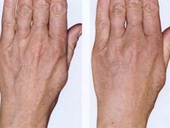 Фракционная мезотерапия кожи рук