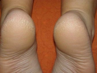 Для отшелушивания кожи ног thumbnail