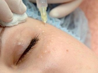 Препараты для биоревитализации вокруг глаз