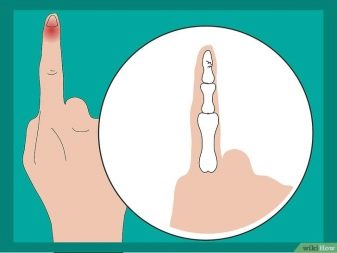 Как вылечить матрикс ногтя