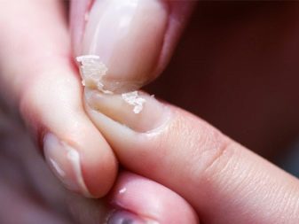 Как вылечить матрицу ногтя