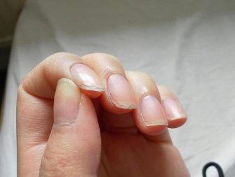 Как вылечить матрицу ногтя