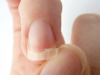 Слоящиеся ногти: причины, лечение и профилактика