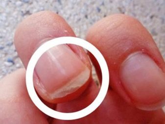 Слоящиеся ногти: причины, лечение и профилактика