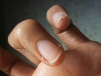Анатомия и физиология кожи рук и ногтей