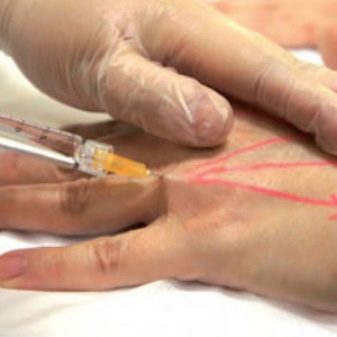 Инъекции для кожи кистей рук