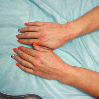 Инъекции для кожи кистей рук