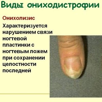 Ожог ногтевой пластины после шеллака фото