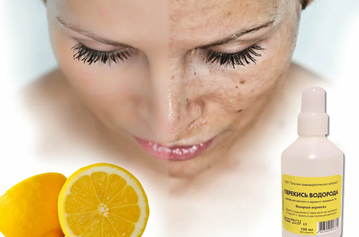 Лучшее средство от пятен на лице. Лимон для лица отбеливание. Отбеливающее от пигментации на лице. Отбеливание кожи от пигментации.