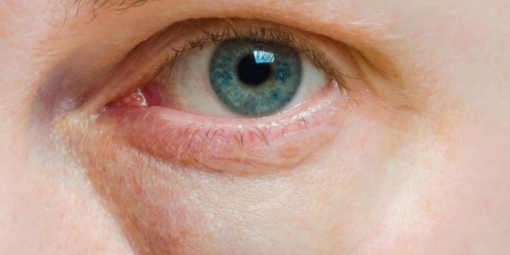 Биоревитализация от морщин вокруг глаз