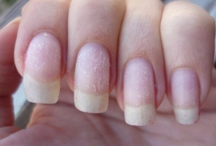 Как вылечить ногти после шеллака