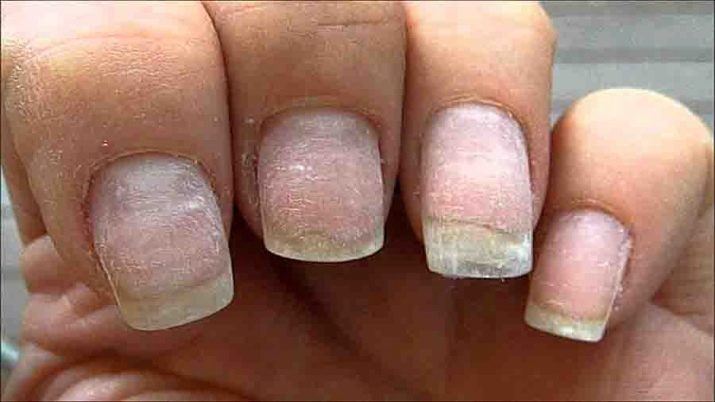 Как вылечить ногти после шеллака и наращивания ногтей thumbnail