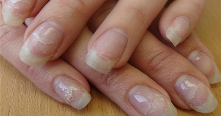 Как вылечить ногтевую пластину после шеллака