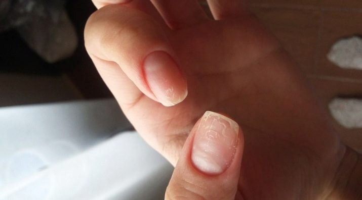Как вылечить ногти после шилака