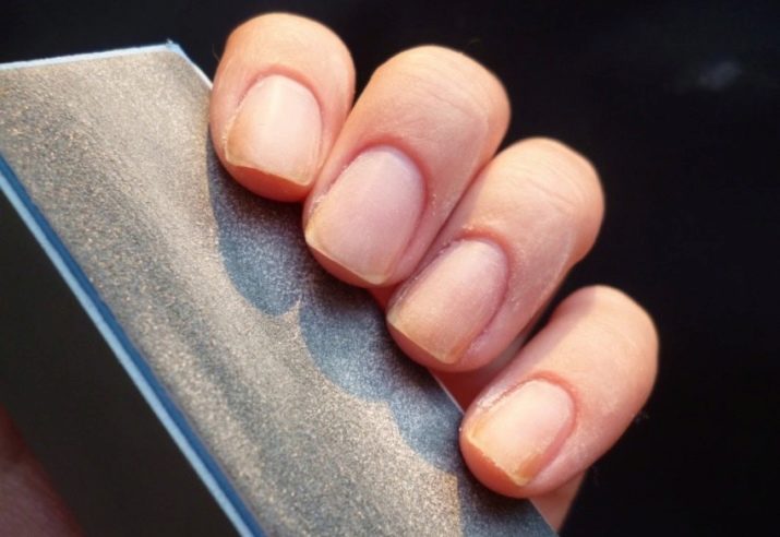 Как вылечить ногти от шеллака