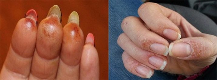 Побочные действия при наращивании ногтей