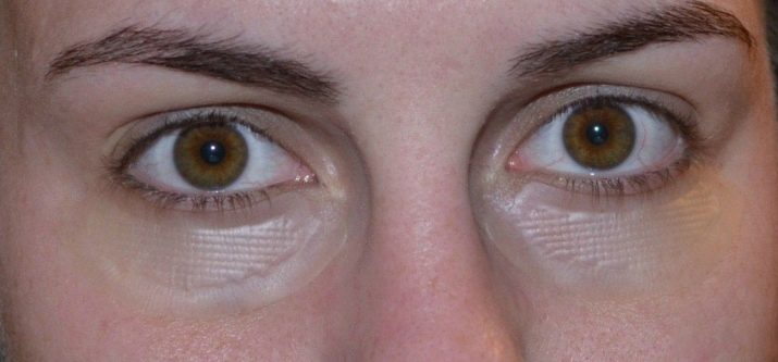 Патчи с гиалуроновыми микроиглами для области вокруг глаз