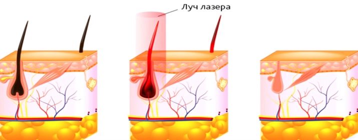 Лазерная эпиляция на сосках противопоказания